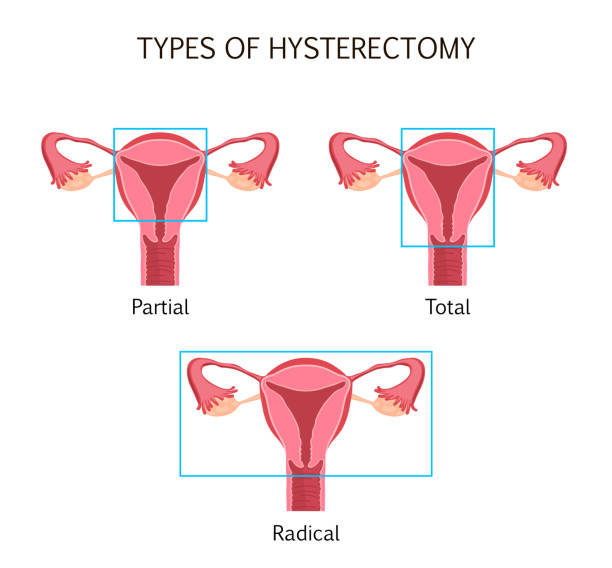 Types of Hysterectomy