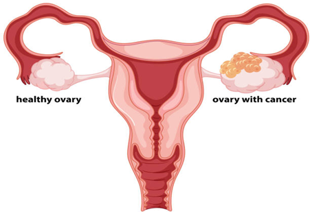 ovarian cancer